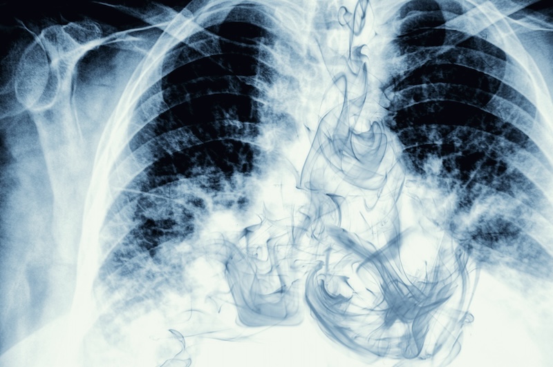 Lung X-Ray