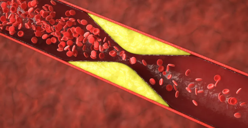 Graphic of blocked artery