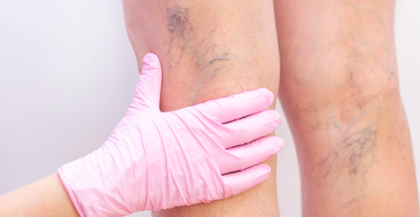 Person with Varicose Veins